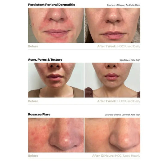 Acide Hypoclorique - Hale Derma