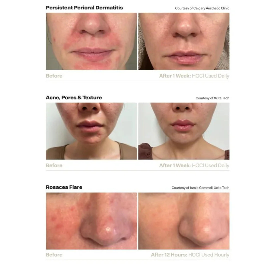 Acide Hypoclorique - Hale Derma