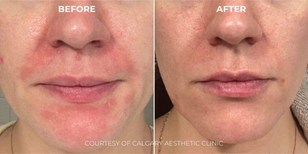Acide Hypoclorique - Hale Derma