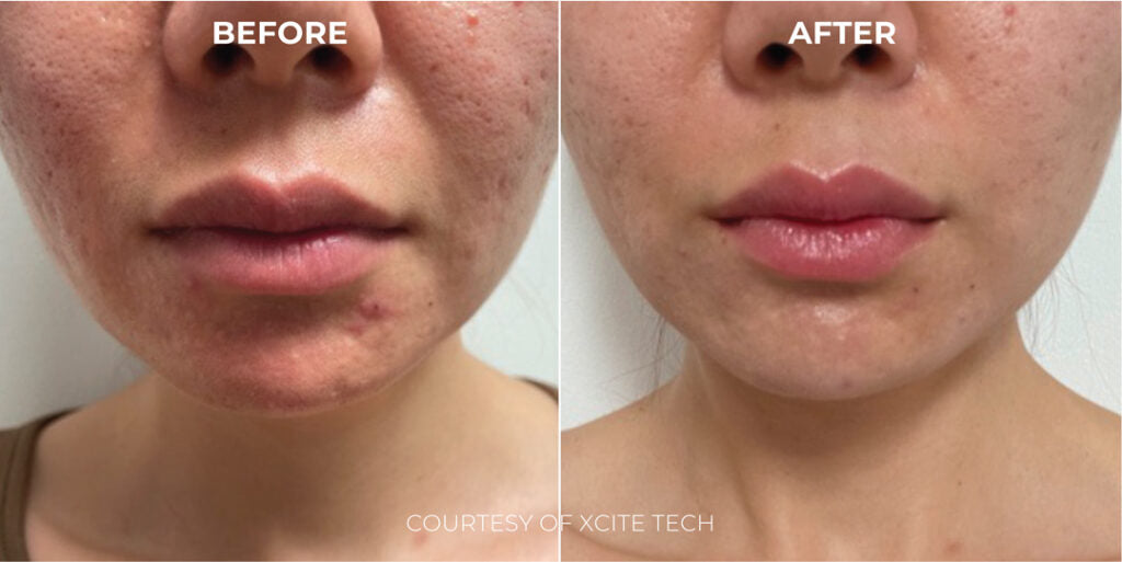 Acide Hypoclorique - Hale Derma