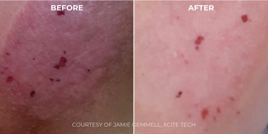 Acide Hypoclorique - Hale Derma